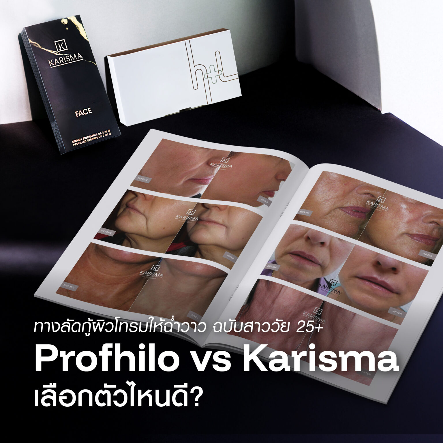Karisma Inject Profhilo vs Karisma เลือกตัวไหนดี? เจาะลึกเทคนิค BAP Injection ทางลัด ...